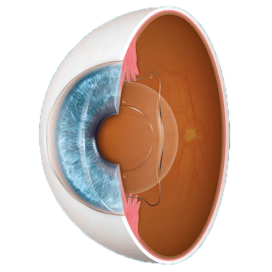 Lens procedures